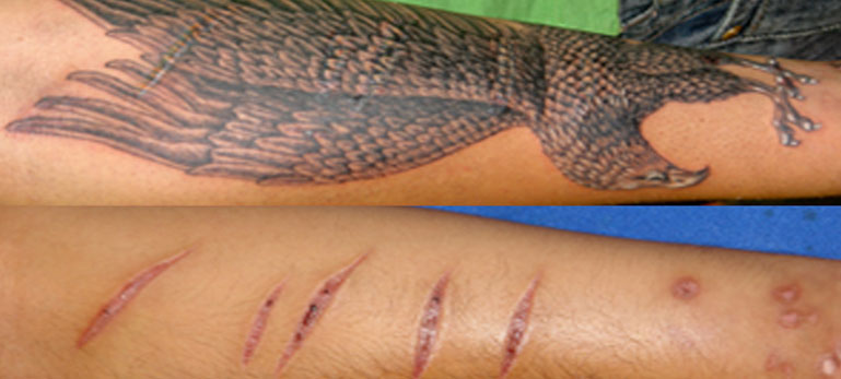 SCAR COVERUP TATTOOS